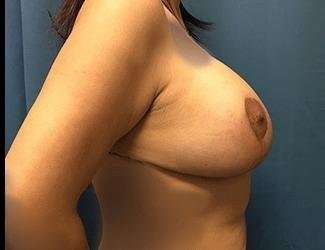 Breast Lift Before & After Patient #1954