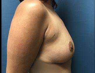 Breast Lift Before & After Patient #1965