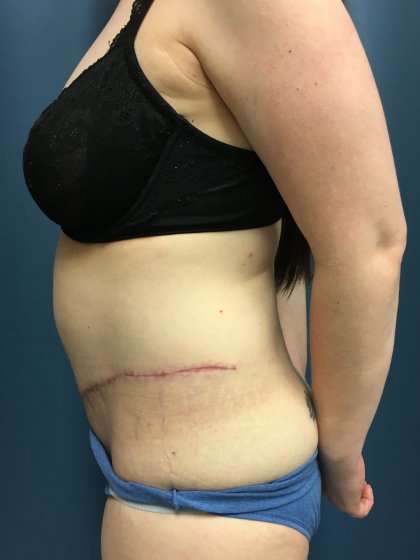 Tummy Tuck Before & After Patient #428