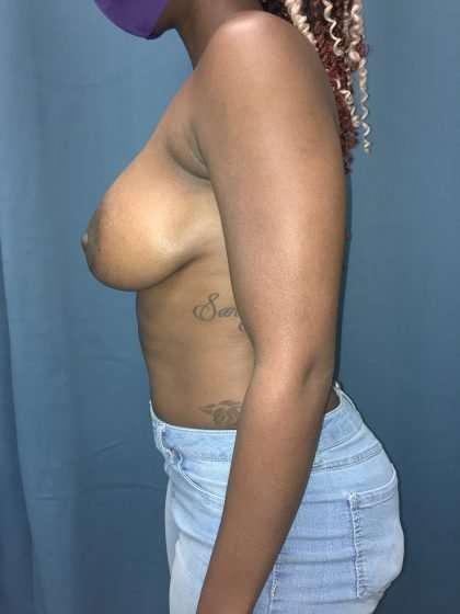 Breast Lift Before & After Patient #2016