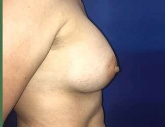 Breast Augmentation Before & After Patient #2069