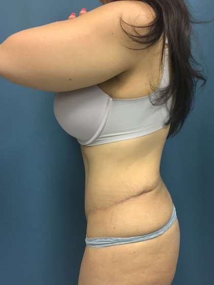 Tummy Tuck Before & After Patient #439