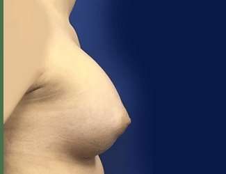 Breast Augmentation Before & After Patient #2102