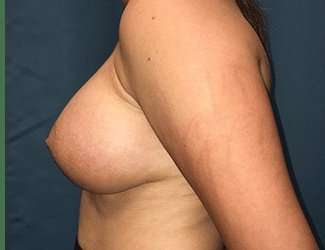 Breast Augmentation Before & After Patient #2144