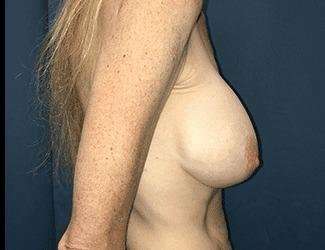 Breast Augmentation Before & After Patient #2162