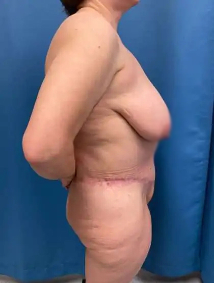 Tummy Tuck Before & After Patient #446
