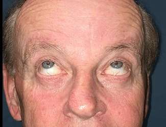 Blepharoplasty Before & After Patient #2251