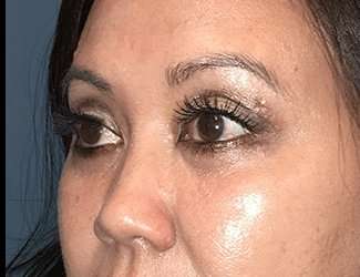 Blepharoplasty Before & After Patient #2260