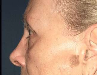 Blepharoplasty Before & After Patient #2271