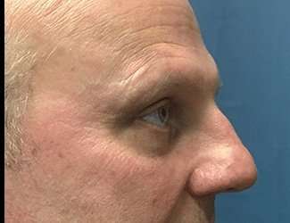Blepharoplasty Before & After Patient #2282