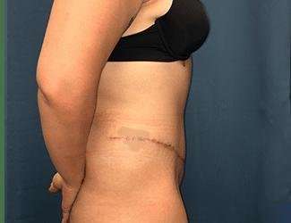 Tummy Tuck Before & After Patient #457
