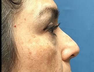 Blepharoplasty Before & After Patient #2293