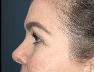 Blepharoplasty Before & After Patient #2315