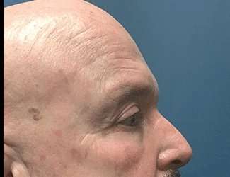 Blepharoplasty Before & After Patient #2328