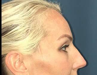 Blepharoplasty Before & After Patient #2339