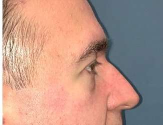 Blepharoplasty Before & After Patient #2352
