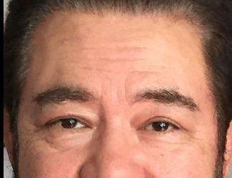 Blepharoplasty Before & After Patient #2355