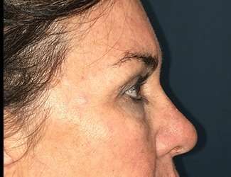 Blepharoplasty Before & After Patient #2368