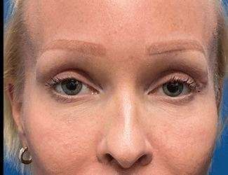 Blepharoplasty Before & After Patient #2371