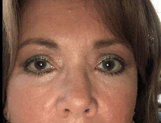 Blepharoplasty Before & After Patient #2374