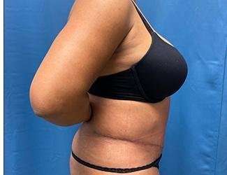 Tummy Tuck Before & After Patient #468