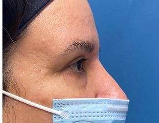 Blepharoplasty Before & After Patient #2385