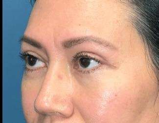 Blepharoplasty Before & After Patient #2390