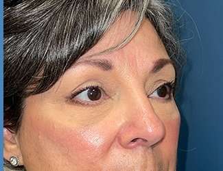 Blepharoplasty Before & After Patient #2397