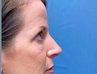 Blepharoplasty Before & After Patient #2408