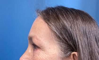 Blepharoplasty Before & After Patient #2419