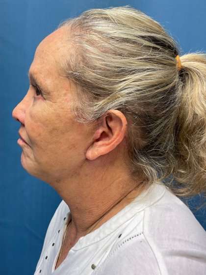 Blepharoplasty Before & After Patient #2430