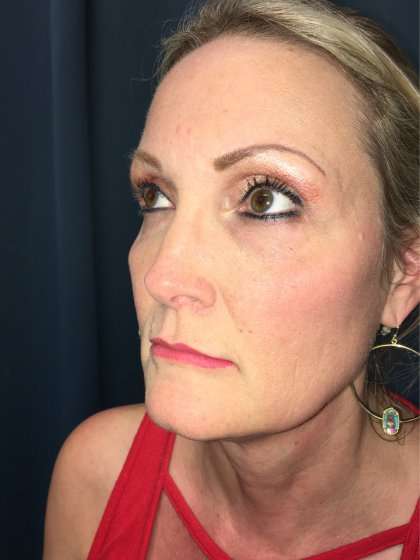 Blepharoplasty Before & After Patient #2437