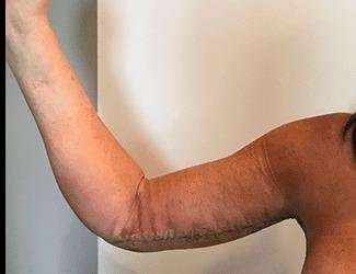 Arm Lift Before & After Patient #2461