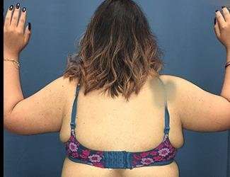 Arm Lift Before & After Patient #2464