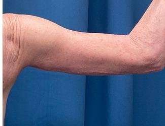 Arm Lift Before & After Patient #2473