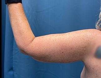 Arm Lift Before & After Patient #2482