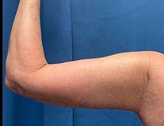 Arm Lift Before & After Patient #2491