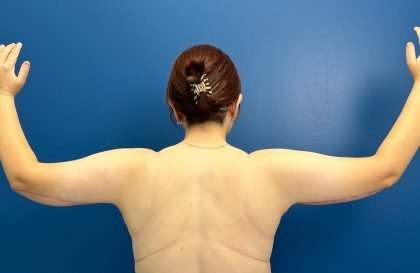Arm Lift Before & After Patient #2498