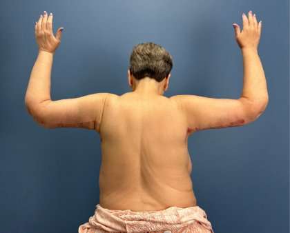 Arm Lift Before & After Patient #2503