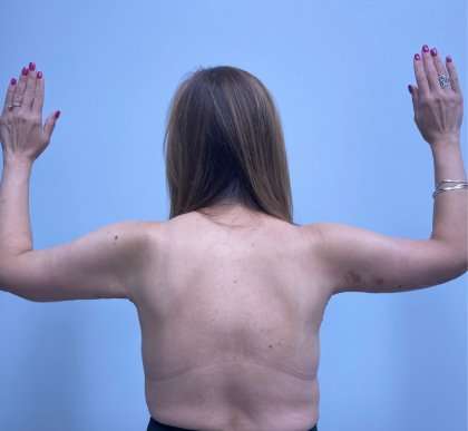 Arm Lift Before & After Patient #2508