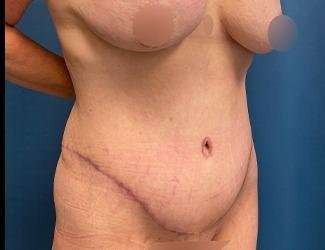 Tummy Tuck Before & After Patient #482