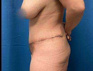 Tummy Tuck Before & After Patient #493
