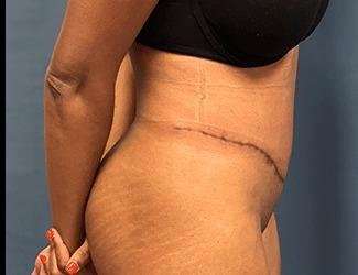 Tummy Tuck Before & After Patient #504