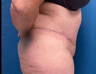 Tummy Tuck Before & After Patient #515
