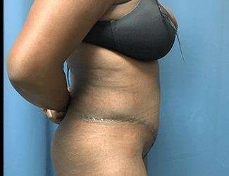 Tummy Tuck Before & After Patient #528