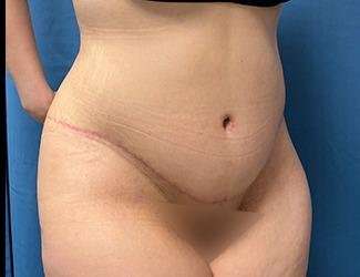 Tummy Tuck Before & After Patient #535