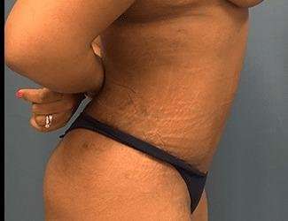 Tummy Tuck Before & After Patient #546