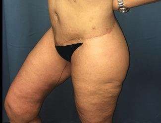 Thigh Lift Before & After Patient #558