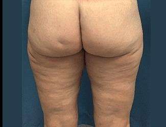 Thigh Lift Before & After Patient #563