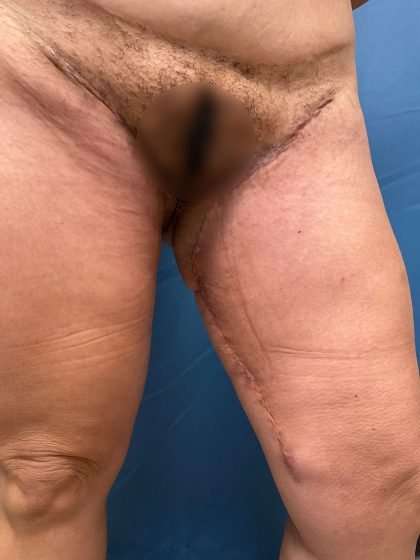 Thigh Lift Before & After Patient #570